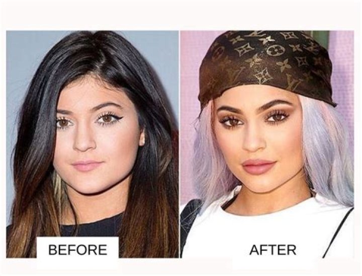 Kylie Jenner Plastic Surgery